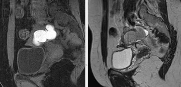 МРТ малого таза в сагиттальной плоскости