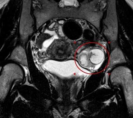 МРТ малого таза в корональной плоскости