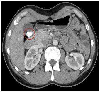 Конкременты в желчном пузыре при КТ
