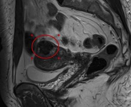 МРТ малого таза в сагиттальной плоскости