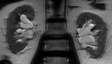  МР-урография в выявлении заболеваний мочевых путей