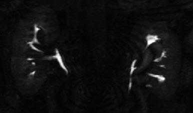  МР-урография в выявлении заболеваний мочевых путей