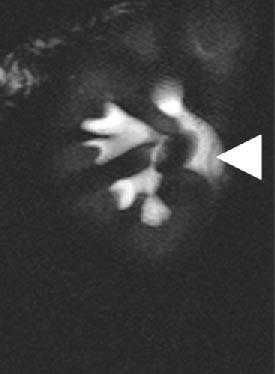  МР-урография в выявлении заболеваний мочевых путей