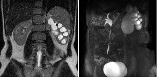  МР-урография в выявлении заболеваний мочевых путей