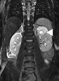  МР-урография в выявлении заболеваний мочевых путей