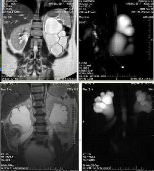  МР-урография в выявлении заболеваний мочевых путей