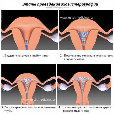 ГСГ УЗИ маточных труб эхогистерография