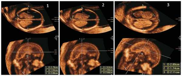Ультразвуковая картина сосудистых сплетений боковых желудочков у плода с открытым дефектом позвоночника