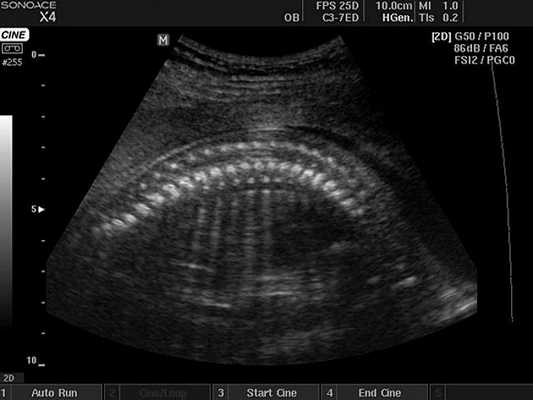 Плод - позвоночник, B-режим (эхограмма №414)