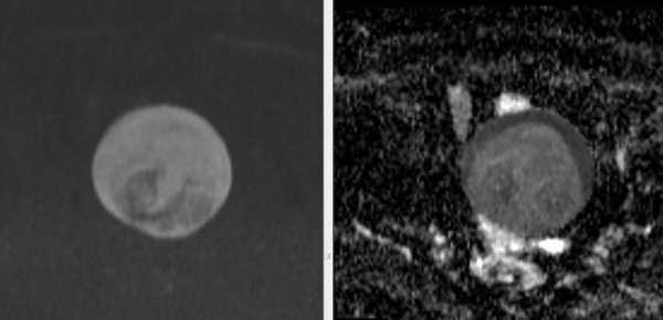 МРТ малого таза