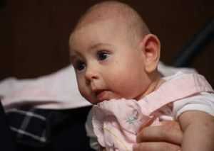 Микроцефалия