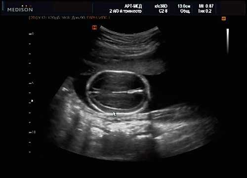 Эхограмма - гидроцефалия, беременность 20 недель 