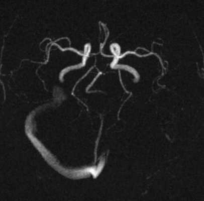 Некоторые клинические проявления внутричерепной венозной гипертензии при односторонней аплазии и гипоплазии сигмовидного и поперечного синусов твёрдой мозговой оболочки