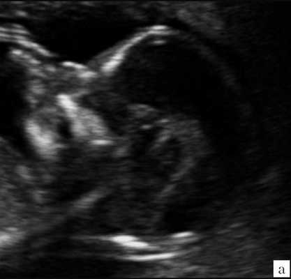 Эхограмма - изменение анатомии мозга плода при spina bifida: отсутствие визуализации IV желудочка, большой цистерны