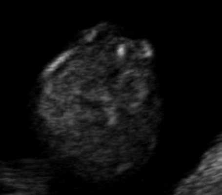 Эхограмма - рахисхиз в поясничном отделе позвоночника плода