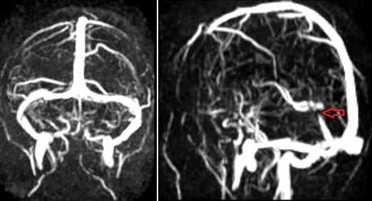 Применение МРТ в исследовании вен головного мозга