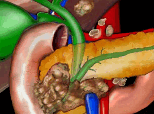 неоперабельная опухоль поджелудочной