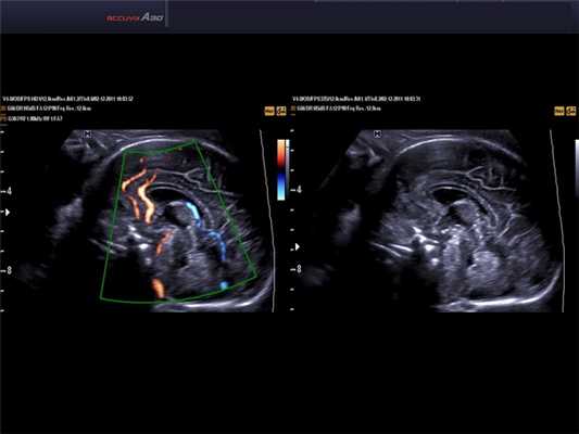 Головной мозг плода, DPDI и DMR (эхограмма №566)