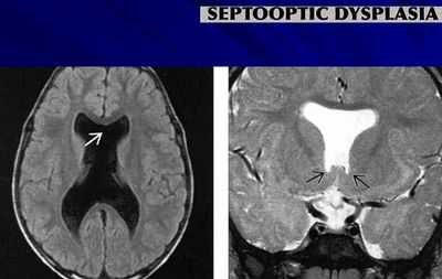 Анэнцефалия