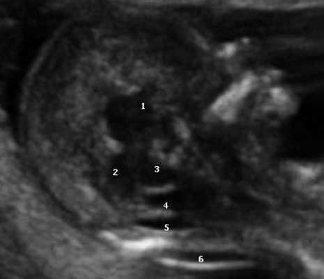 Ультразвуковая соноэмбриология структур головного мозга плода: 1 - диэнцефалон; 2 - средний мозг; 3 - ствол мозга; 4 - интракраниальное пространство, или IV желудочек; 5 - большая цистерна; 6 - воротниковое пространство