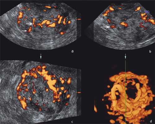 Эхограммы с энергетической допплерографией органов малого таза у больной