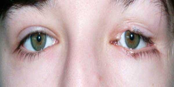 колобома века