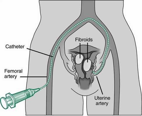 миома матки операция