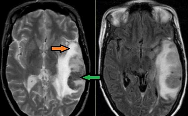 Применение МРТ в исследовании вен головного мозга