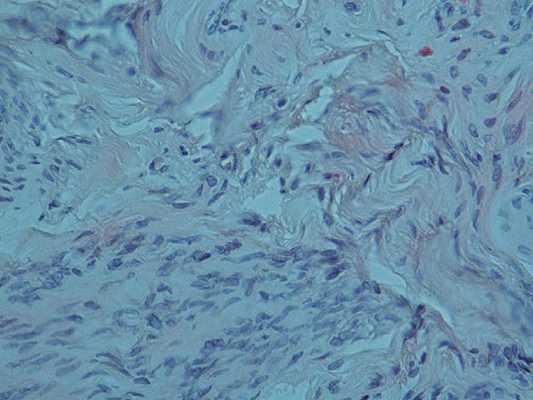 Микропрепарат миомы тела матки с дистрофическими изменениями