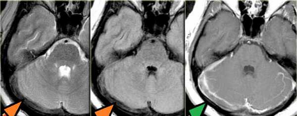 Применение МРТ в исследовании вен головного мозга