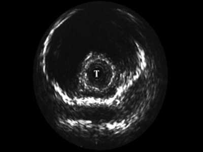 УЗИ: эхограмма мочеиспускательного канала - нормальная губчатая часть