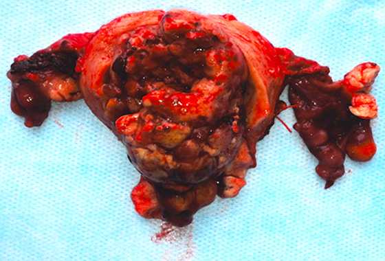 Макропрепарат: удаленная матка с придатками