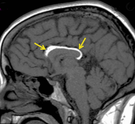 Липома на МРТ головного мозга