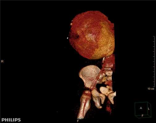 3D-реконструкции опухоли Вильмса