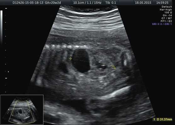 Эхограмма - кистозное образование у верхнего полюса левой почки плода