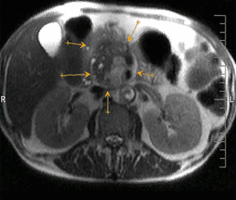Рак поджелудочной железы на МРТ