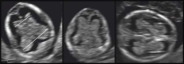 Ультразвуковые картины «бабочки» сосудистых сплетений боковых желудочков головного мозга плода (норма)