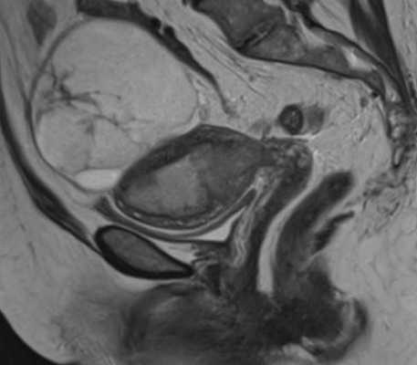 Субсерозная миома на МР-сканировании