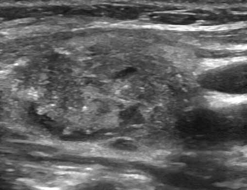 УЗИ щитовидной железы