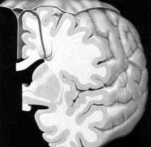Применение МРТ в исследовании вен головного мозга