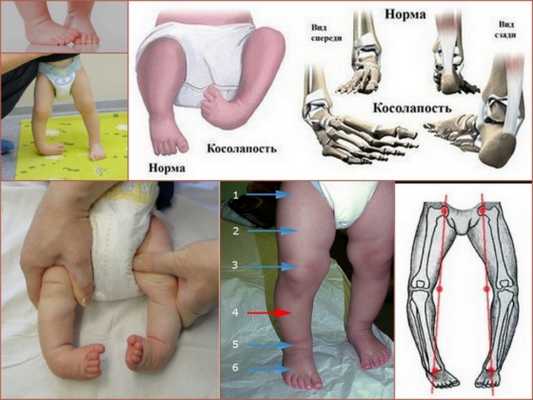 Как выглядит косолапие у ребенка