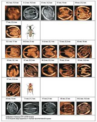 Эхографическая картина аксиального среза сосудистых сплетений на уровне крыши III желудочка у всех плодов с ОДП и сравнение с хитиновыми оболочками «тараканов»
