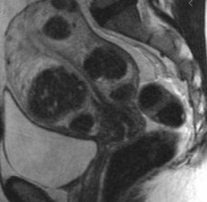 Множественная миома матки больших размеров на МРТ