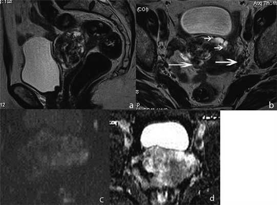 МР-томограммы органов малого таза пациентки
