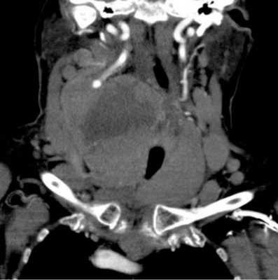 КТ щитовидной железы фото