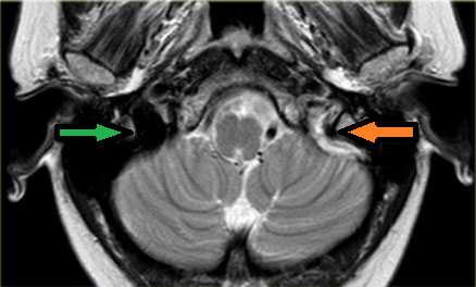 Применение МРТ в исследовании вен головного мозга