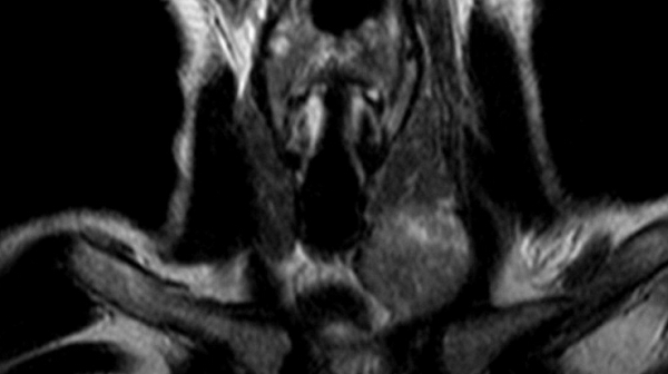 МРТ щитовидной железы