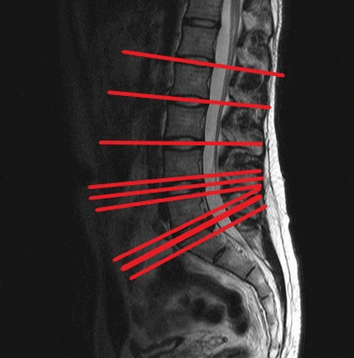 межпозвоночные диски на МРТ