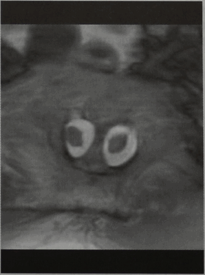 Снимки МРТ и КТ. Диастематомиелия (удвоение спинного мозга)