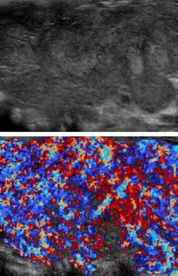 Патологическое усиление кровотока в органе: диффузный токсический зоб